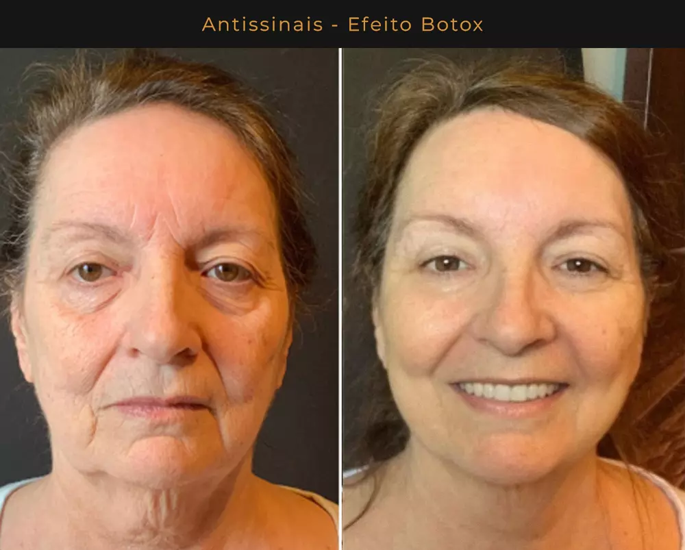 Hidra Pele Antissinais - Efeito Botox